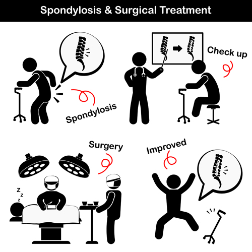Spondylose mit chirurgischer Behandlungsvektor Spondylose Chirurgie Behandlung   